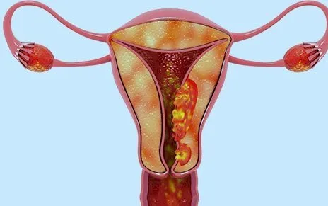 Imagen del artículo CANCER DE ENDOMETRIO