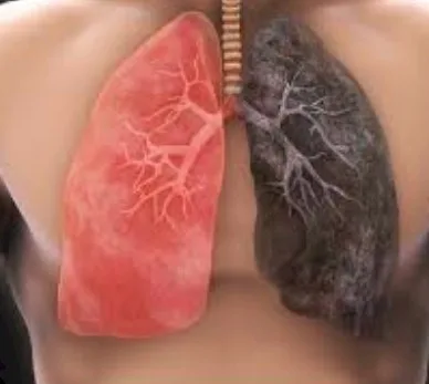 Imagen del artículo El cáncer de Pulmón
