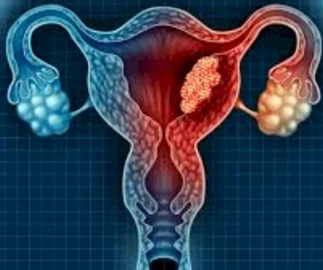 Imagen del artículo cáncer de Útero. Cuáles son los factores de riesgo?