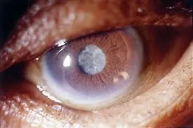 Cataratas: causas y tratamiento