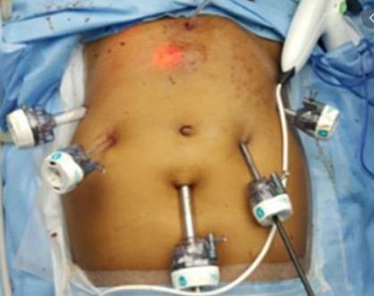cirugia laparoscopica guayaquil