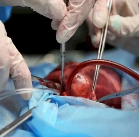 Imagen del artículo Cirugía Cardiotorótica Mini Invasiva