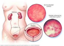 La cistitis una enfermedad femenina mas comás de lo que parece