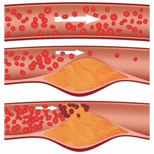 Imagen del artículo Colesterol bueno vs Colesterol Malo