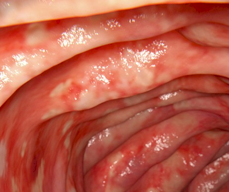 colitis ulcerosa