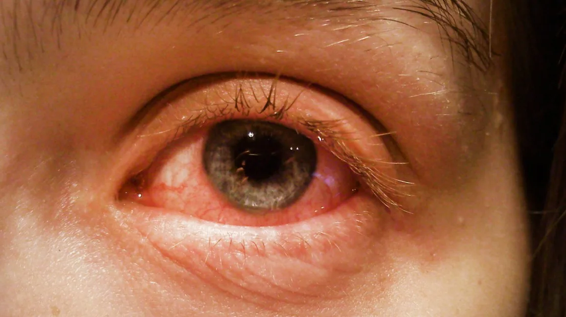 Conjuntivitis