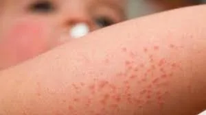 Dermatitis