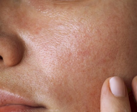dermatitis de contato