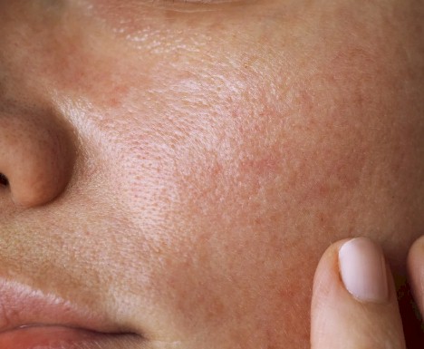 dermatitis de contato