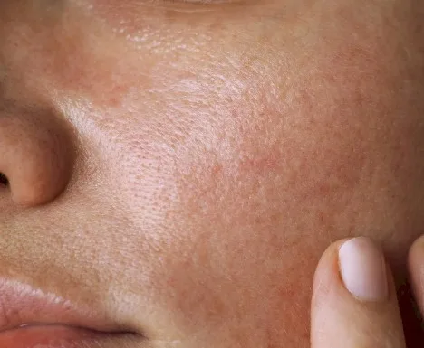 Imagen del artículo Dermatitis de contacto