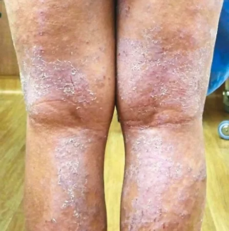 Imagen del artículo Dermatítis atópica o Eczema