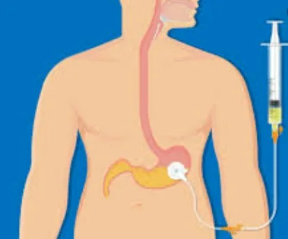 Imagen del artículo GASTROSTOMIA ENDOSCOPICA PERCUTANEA