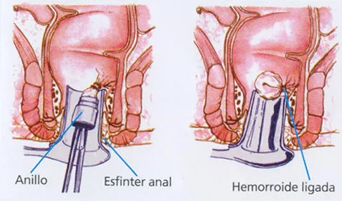 Enfermedad hemorroidal