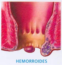 Enfermedad hemorroidal