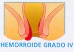 Enfermedad hemorroidal