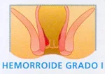 Enfermedad hemorroidal