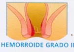 Enfermedad hemorroidal