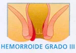 Enfermedad hemorroidal
