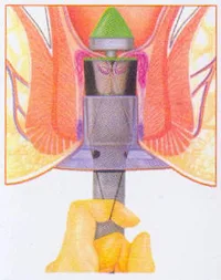 Enfermedad hemorroidal