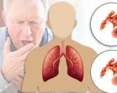 Imagen del artículo Enfermedad Pulmonar Obstructiva Crótica EPOC