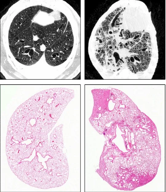 Imagen del artículo Fibrosis pulmonar