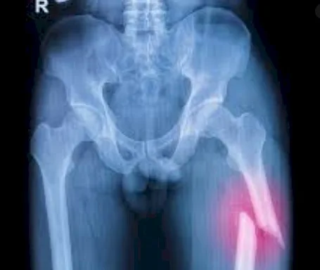 Imagen del artículo Fracturas