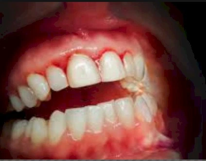 Imagen del artículo GINGIVECTOmás