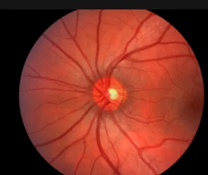 Imagen del artículo Detección temprana del Glaucoma
