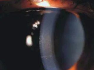 Glaucoma Pigmentatario