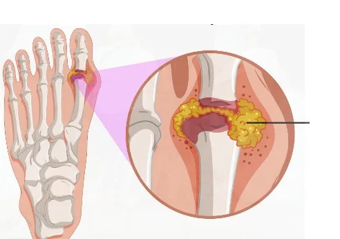 Imagen del artículo La Gota, una enfermedad reumática