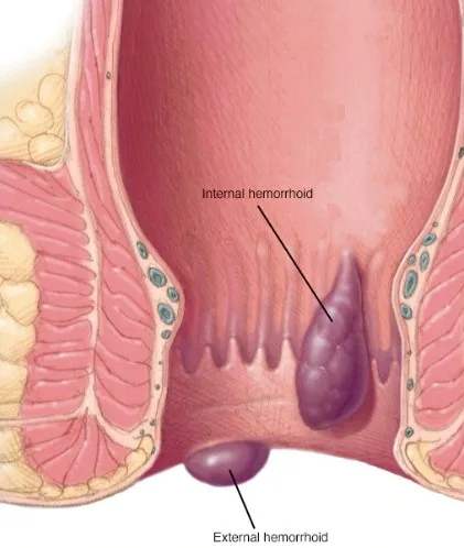 Imagen del artículo Enfermedad hemorroidal