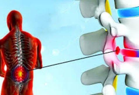 Hernias discales, Lo que se debe saber acerca de las