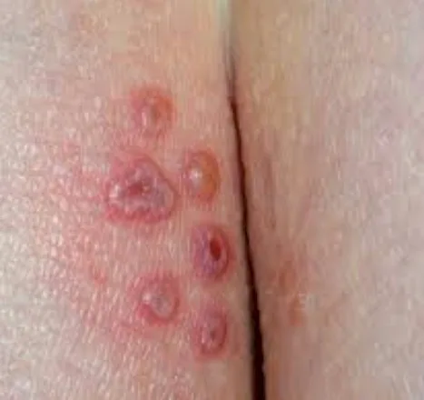 Imagen del artículo Herpes Genital - Infección y Enfermedad