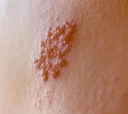 Imagen del artículo Es el Herpes genital una enfermedad venárea ?