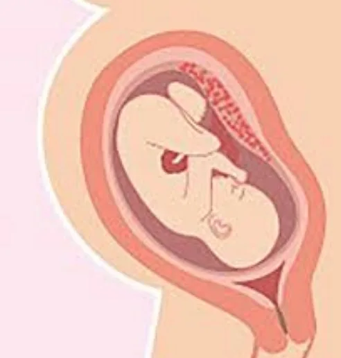 Imagen del artículo Inducción del parto