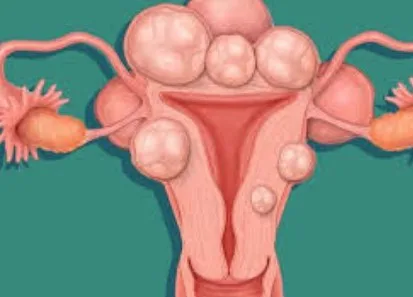 Imagen del artículo Qué son los miomas del Útero ?