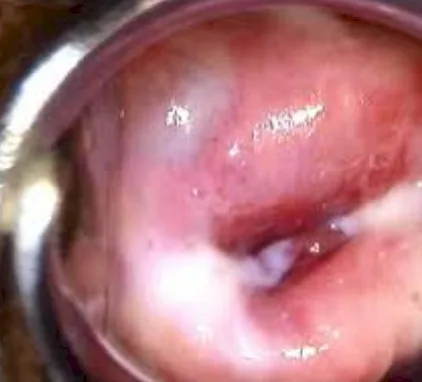 Imagen del artículo Infección genital por Clamydia Trachomatis