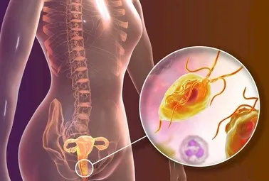 Imagen del artículo Infección vaginal por parásitos