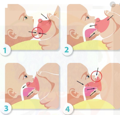 LESION SENO LACTANCIA