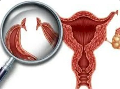 Imagen del artículo Cuáles son las ventajas y desventajas de la ligadura en la mujer ?