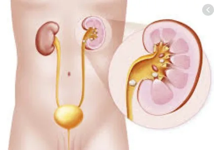 Imagen del artículo Cálculos urinarios (litiasis)
