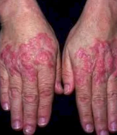 Imagen del artículo ¿Qué es el Lupus Eritematoso Sistémico?