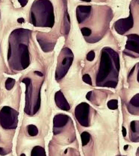 Imagen del artículo Qué es la osteoporosisí Se puede evitar su aparición?