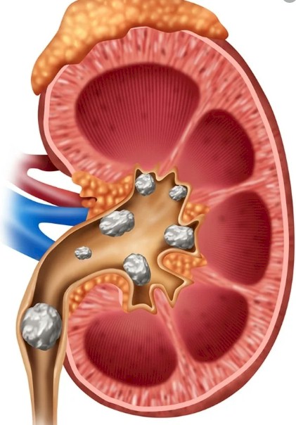 calculos vias urinarias