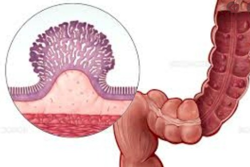 Pólipos de colon y recto Pólipos de colon y recto
