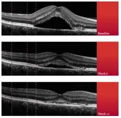 CIRUGIA DE RETINA Guayaquil