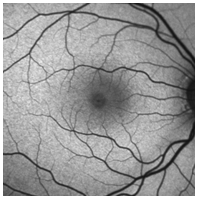 RETINA TUMOR