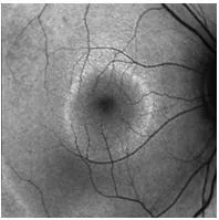 Uso de Láser en problemas de retina - Dr. Rivera - Guayaquil Ecuador