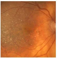 PROBLEMA RETINA