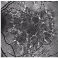 Uso de Láser en problemas de retina - Dr. Rivera - Guayaquil Ecuador